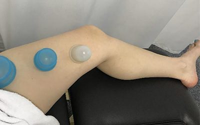 Scrape, Tape, Cup & Glide: Restoring Space, Motion, & Slack for Restricted Neural Dynamics of the Lower Quarter